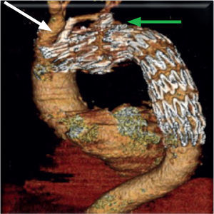 Angio-TC realizado ao 1° mês constatando-se exclusão do aneurisma, permeabilidade do sent carotídeo (seta branca) e embolização da ASE (seta verde).