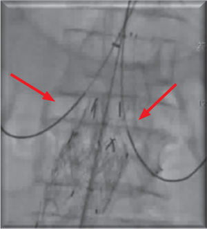 Cateterização da ambas as artérias renais (seta vermelha).