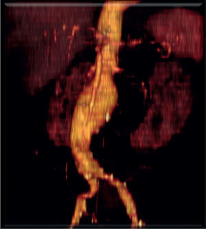 Angio-TC pré-operatório observando-se aneurisma justa-renal.