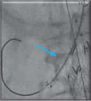 Libertação do stent revestido a ePTFE 6×50mm na artéria renal direita (seta azul).