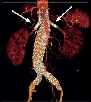 Angio-TC realizada ao 1° mês de pós-operatório constatando-se exclusão completa do aneurisma e permeabilidade das duas artérias renais.