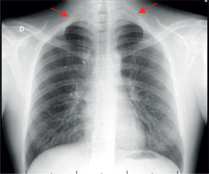 Radiografia de tórax: costela cervical bilateral, completas, com articulação com a 1ª costela (setas vermelhas).