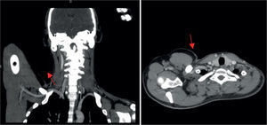 AngioTC: estenose da artéria subclávia direita. A. Corte coronal; B. Corte axial.