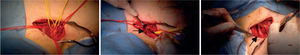 Imagens intra-operatórias. A. Plexo braquial em slings amarelos e artéria subclávia em slings vermelhos; B. Costela cervical (seta preta); C. Dilatação pos-estenótica da artéria subclávia (seta preta).