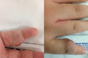 Malformação arteriovenosa do 5° dedo da mão direita - aspecto palmar e dorsal