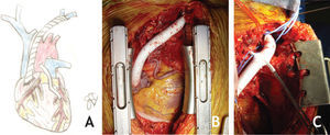 A-C. Cirurgia: A. Esquema da cirurgia – bypass aorta-DA e bypass da veia braquicefálica-aurícula direita; B. Imagem intra-operatória; C. Pormenor da anastomose venosa proximal