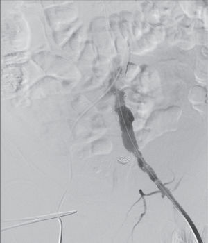 Angiografia final de controlo após colocação da endoprótese e angioplastia das zonas de selagem