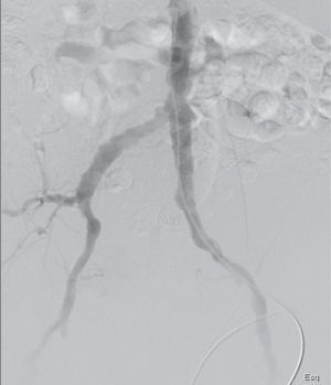 Angiografia de controlo após colocação de stent expansível por balão intra-endoprótese, sem estenose residual