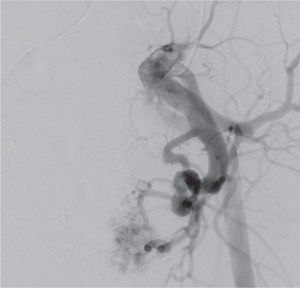 Angiografia pélvica demonstra a presença de uma malformação arteriovenosa com origem em ramos da artéria ilíaca interna esquerda