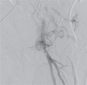 Arteriograma do eixo ilíaco esquerdo, doze meses após primeira emboloterapia, mostra persistência das comunicações arteriovenosas com repermeabilização do nidus da lesão