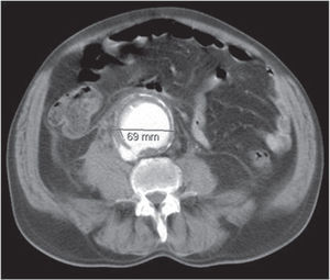 Fístula Aorto-Cava e Aneurisma da Aorta Abdominal de 6,9cm