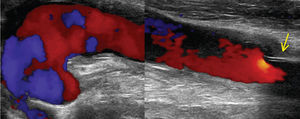 Falso aneurisma axilar, migração distal protésica (seta) e fluxo no canal do prévio trajecto de bypass