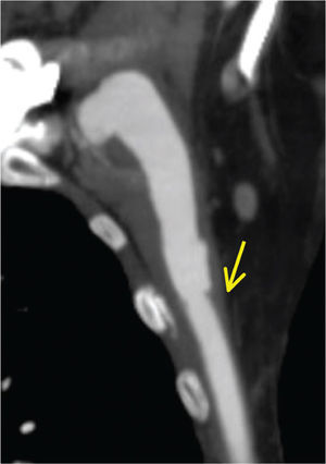 Aspecto do estudo por angioTC com o início da prótese evidenciada pela seta