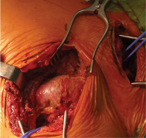 Controlo proximal e distal ao falso aneurisma axilar