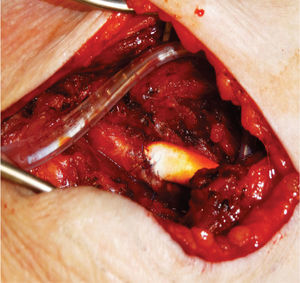 Aspecto final da reconstrução proximal