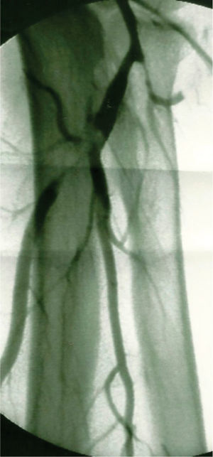 Estudo angiográfico mostrando embolização periférica na origem da artéria inter-óssea e oclusão da artéria radial.
