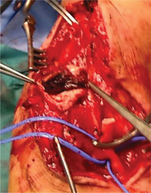 Trombo no interior do saco aneurismático.