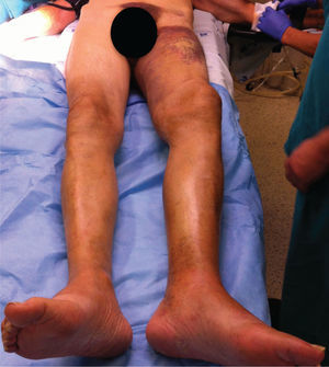 Sufusão hemorrágica da coxa, extenso hematoma popliteu e pé pendente.
