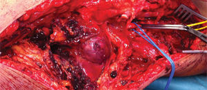 Abordagem por via interna da artéria popliteia supra e infra-genicular.