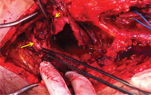 Endoaneurismorrafia proximal (seta longa) e distal (seta curta) na artéria popliteia supra-genicular.