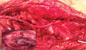 Anastomose distal na artéria popliteia infra-genicular e pormenor da anastomose proximal na artéria femoral superficial.