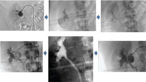 Imagens do procedimento de exclusão do aneurisma renal.