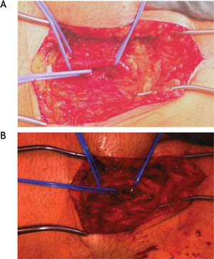 A) Visualização de comunicação entre a veia femoral e artéria femoral profunda. B) Após tratamento da FAV.