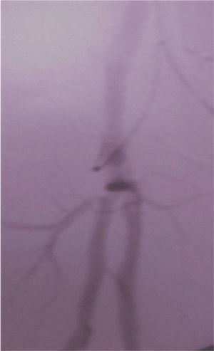 Controlo angiográfico intra-operatório.