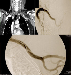 Case 1. Top left: CTA showing distal extension of dissection to the axillary artery and occlusion of the brachial artery. Top right: Intraoperative selective digitally subtracted arteriography confirming CTA findings, diagnostic catheter placed distally to proximal dissection entry flap. Bottom: Completion arteriography.