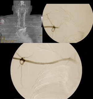 Case 2. Top left: CTA showing large hematoma and occlusion of the distal subclavian and axillary arteries. Top right: retrograde arteriography confirming occlusion of the axillary subclavian artery. Bottom: Completion angiography showing rapid antegrade flow without evidence of endoleaks. Right vertebral artery takeoff is also observed.
