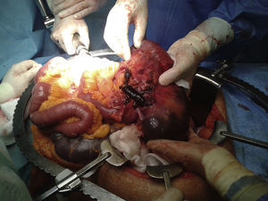 Hipoperfusão do cólon e necrose parietal.