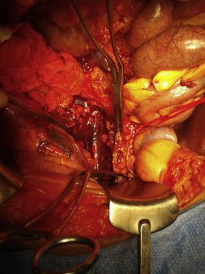 Exteriorização do stent da AIE direita e destruição arterial.
