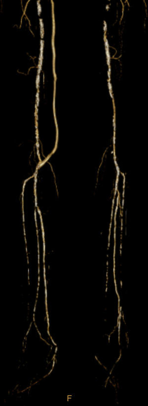 Angio‐TC demonstrando permeabilidade da artéria tibial posterior.