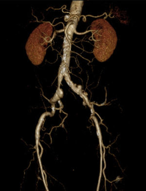 Reconstrução 3D angio‐TC da aorta (sem envolvimento aneurismático desta) e seus ramos.