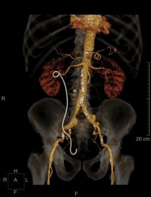 Reconstrução 3D angio‐TC e seus ramos com stent uretérico temporário colocado no ureter direito. Este exame confirmou a ausência de coleções em torno do ureter.