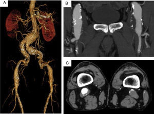 Estudo por angioTC pré‐operatória mostrando doença multianeurismática aorto‐ilíaca, femoral e poplítea bilateral.
