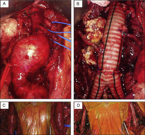 Aspetos intraoperatórios do procedimento de reconstrução proximal realizado, evidenciando a particularidade anatómica de múltiplas artérias renais acessórias.