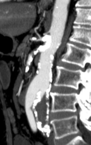 Doença calcificante da placa visceral, com trombose da artéria mesentérica superior.