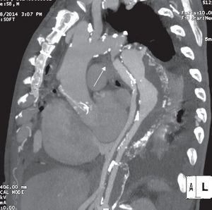 Imagem de coartação grave da aorta (angio‐TC).