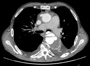 Disseção crónica da aorta tipo B (angio‐TC).