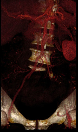 Oclusão da artéria ilíaca externa esquerda (reconstrução de angio‐TC).