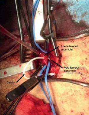 Cateter venoso totalmente implantável atravessando de forma transfixiva a artéria femoral superficial, entrando posteriormente na veia femoral superficial.