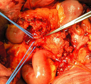 Mycotic aneurysm of the superior mesenteric artery during the surgical procedure.