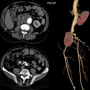Pre-operative CT scan: ectopic right pelvic kidney vascularized by a single artery originated from the anterior wall of the abdominal aortic aneurysm.