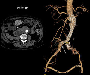 Post-operative CT scan: endovascular successful AAA exclusion, with patent ilio-renal (arrow) and femoral crossover bypasses.