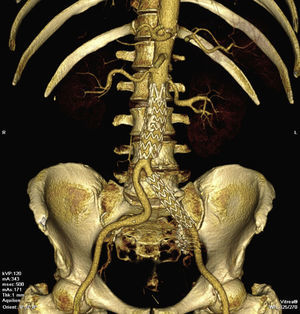 Angio‐TC 3D aos 2 meses após o procedimento.