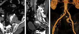 Estudo por angioTC que revela aneurisma da artéria hipogástrica esquerda (pós‐protésico) com 4,5cm de diâmetro.