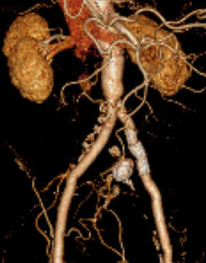 AngioTC de controlo, realizada 2 anos após o procedimento, que confirmou a exclusão do aneurisma hipogástrico esquerdo e a permeabilidade da endoprótese.