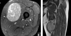 Imagens demonstrativas da RMN realizada pré‐operatoriamente. À esquerda um corte transversal com visualização do tumor e suas relações muscular. À direita uma perspetiva coronal.