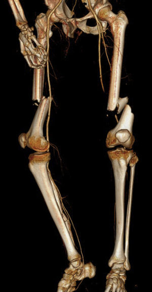 Fratura diafisária de ambos os fémures com oclusão da artéria femoral esquerda (vista anterior).